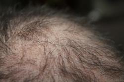 Kopfhaut mit Haarausfall